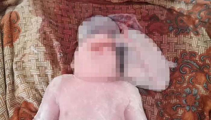 Menyedihkan, Seorang Bayi Lahir Tanpa Tempurung Kepala di Madina