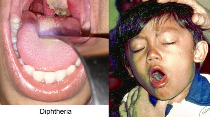 Bocah 5 Tahun Asal Madina Suspect Difteri