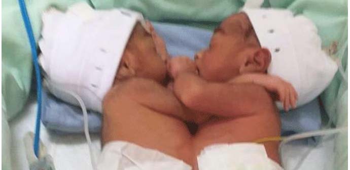 Ibu Asal Labuhanbatu Melahirkan Bayi Kembar Siam di RSUP H Adam Malik