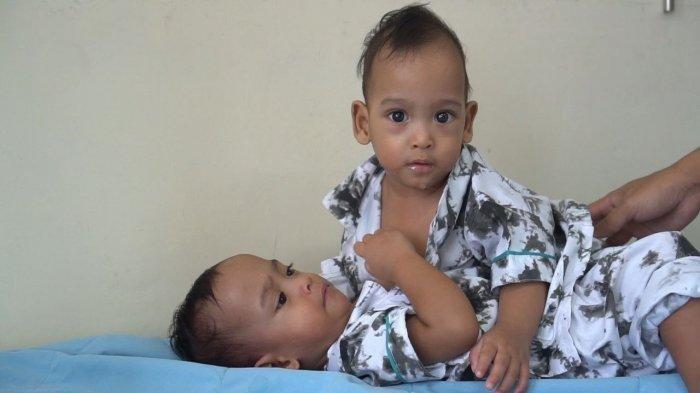 Bayi Kembar Siam dari Labuhanbatu Sehat dan Sudah Boleh Pulang