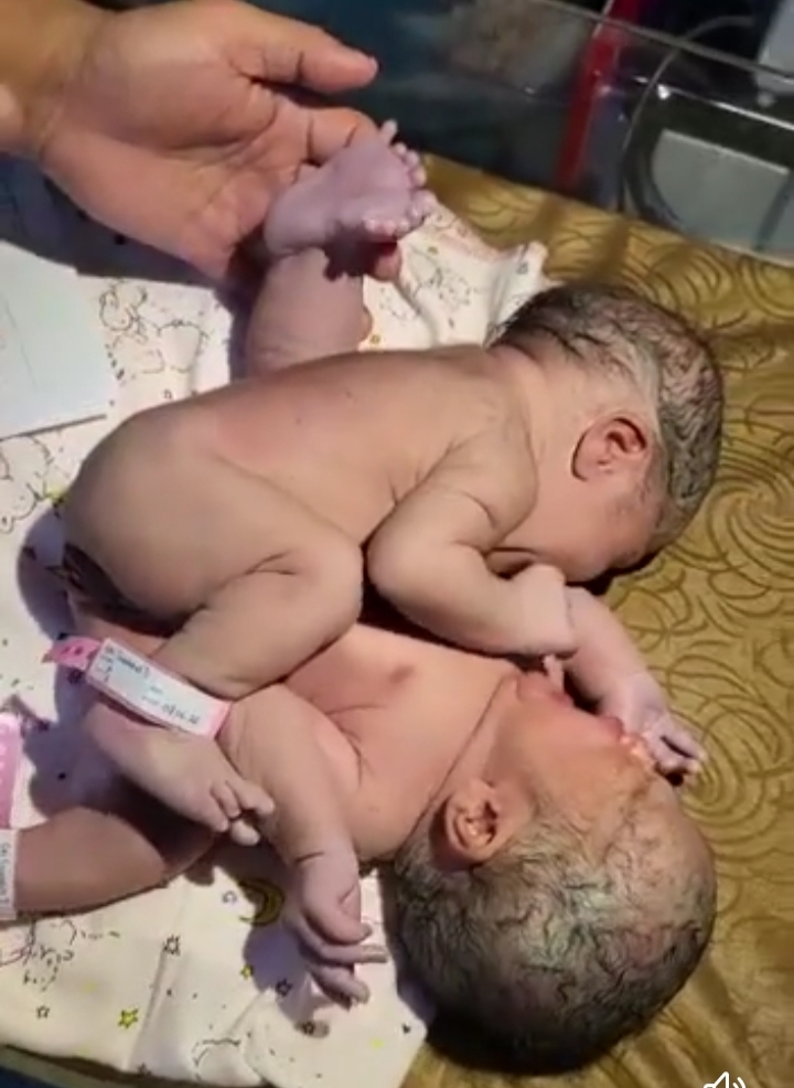 Bayi Kembar Siam Kaki Tiga Lahir di Asahan